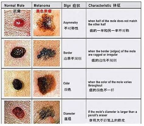 側腰上有痣|【腰側有痣】揭秘腰側有痣的命運：驚人的長壽、財運與家世淵。